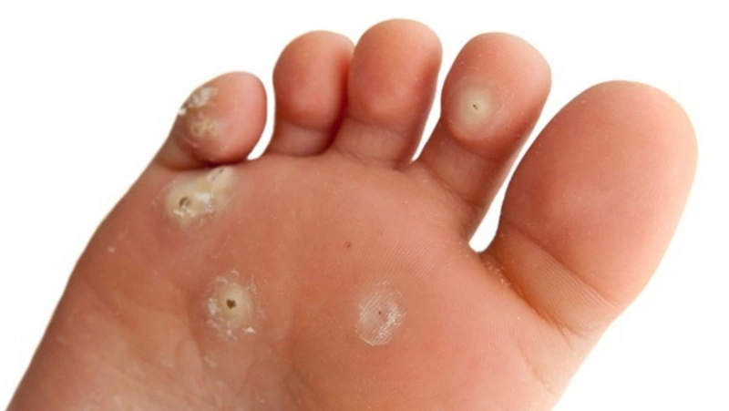 Giải đáp thắc mắc: Mụn cóc có lây không? 1