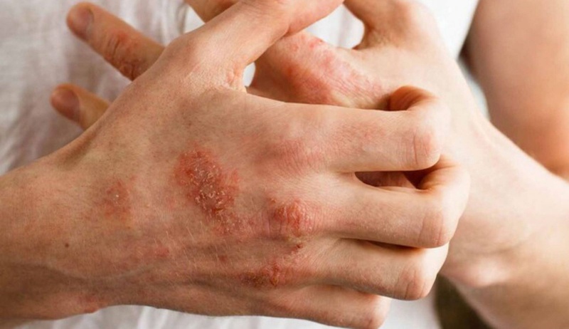 Giải đáp thắc mắc: Mụn cóc có lây không? 4