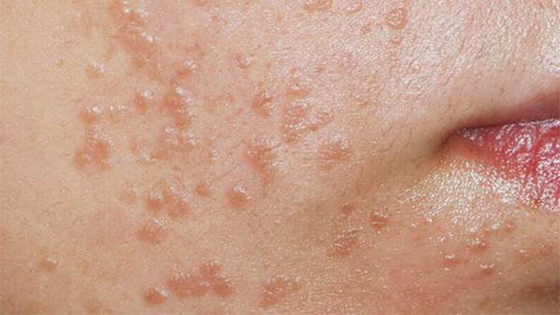 Mụn cóc phẳng là gì Ai dễ lây nhiễm 1