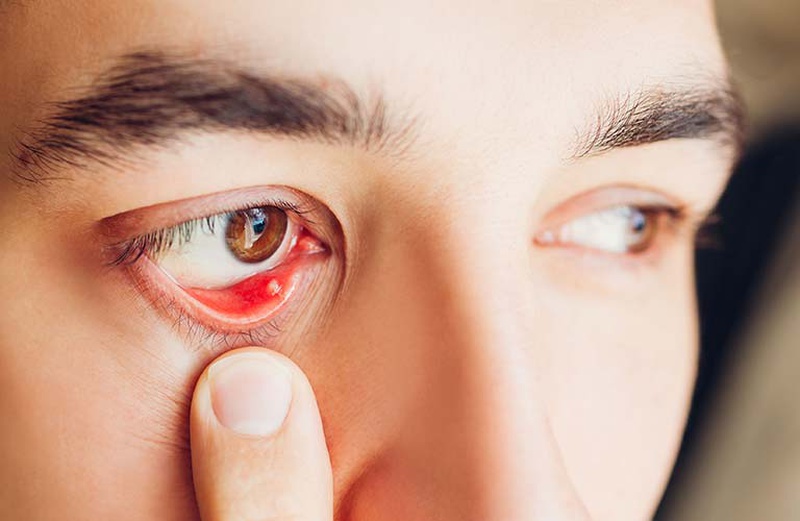 Tìm hiểu về bệnh mắt hột, nguyên nhân và cách thức điều trị 1
