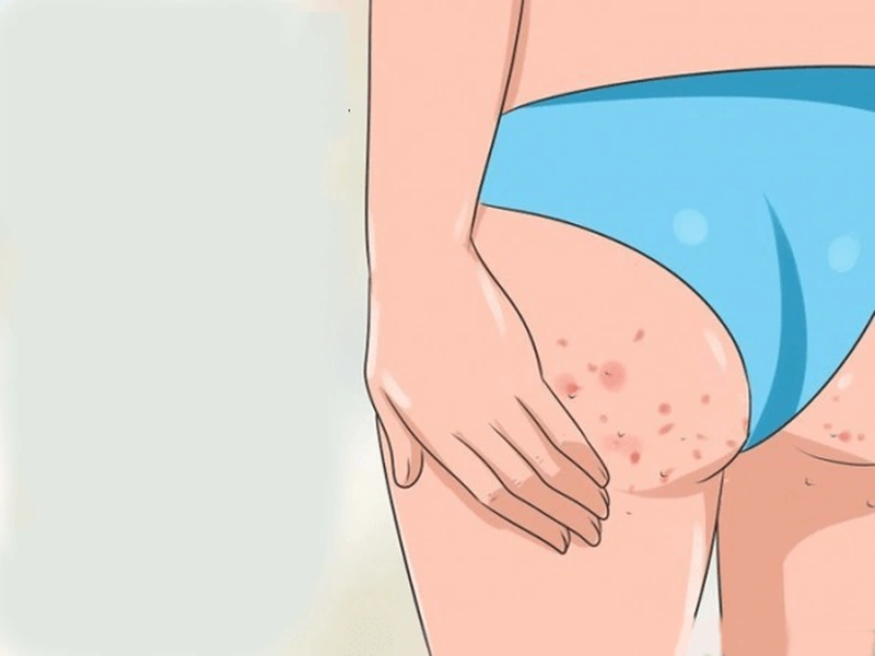 Mụn nhọt ở mông là do đâu có nên nặn không