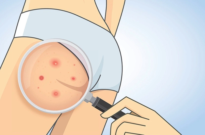 Mụn nhọt ở mông bao lâu thì khỏi