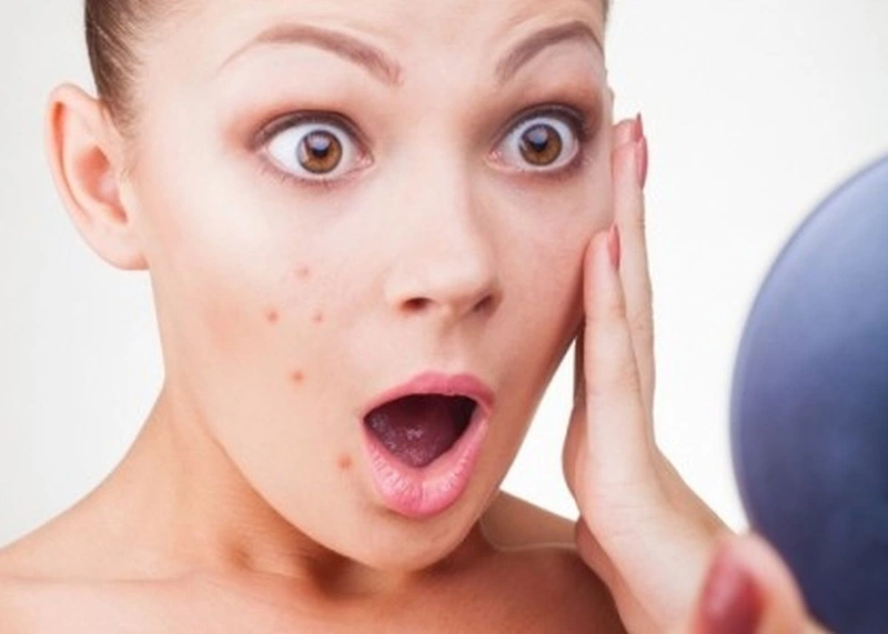 Mụn nội tiết là gì? Cách chữa dứt điểm mụn nội tiết 2