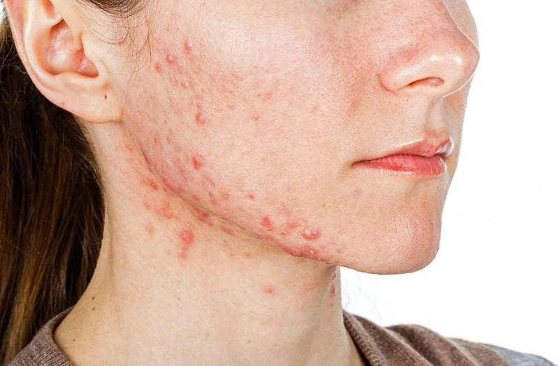 Mụn ở quai hàm: Đặc điểm và cách điều trị mụn hiệu quả 2