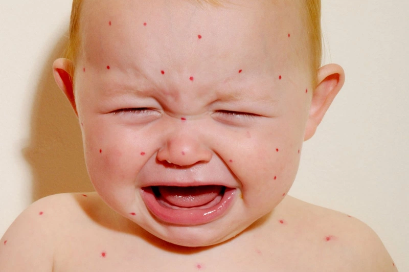 Cách nhận biết dấu hiệu của bệnh sởi, mụn sởi như thế nào 1