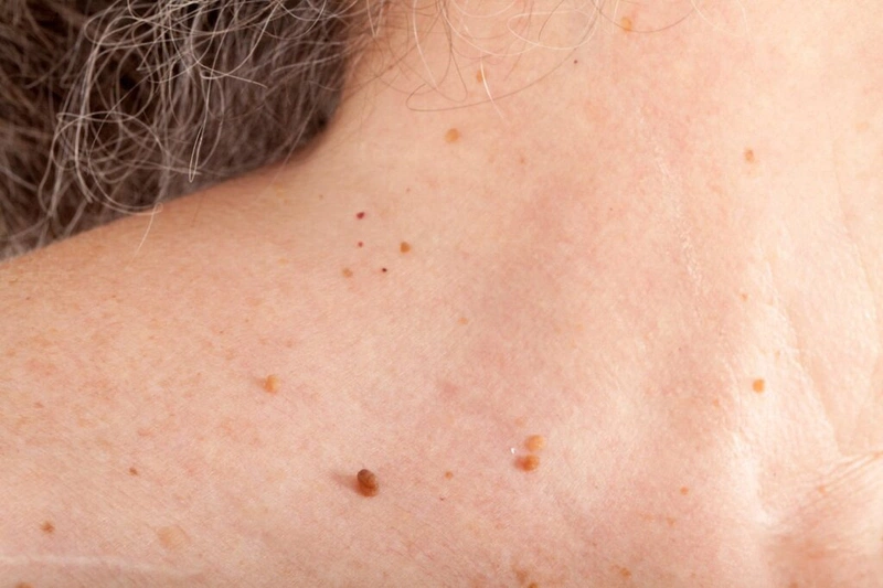 Mụn thịt là gì? Mụn thịt có gây ra biến chứng không? 5