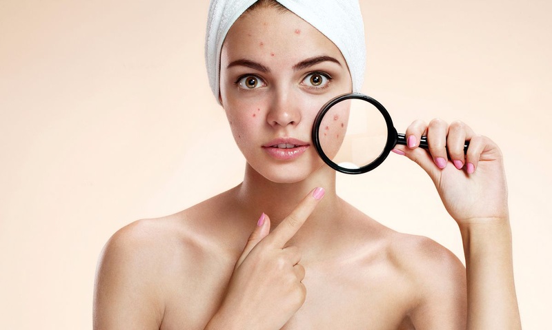Làm thế nào để đối phó với mụn trứng cá tuổi dậy thì