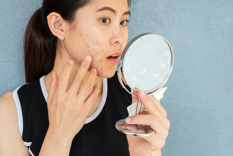 Mụn trứng cá có nên nặn không?1