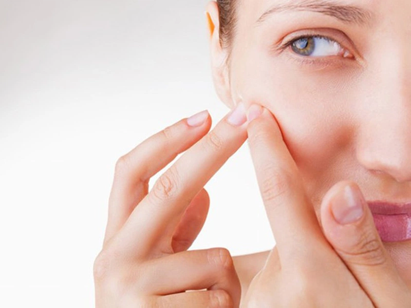 Mụn trứng cá có nên nặn không?2