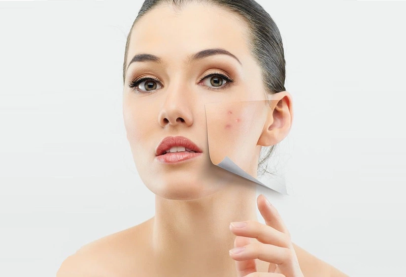 Mụn trứng cá có tự hết được không?1