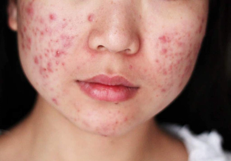 Chắp mắt để lâu có sao không? 1
