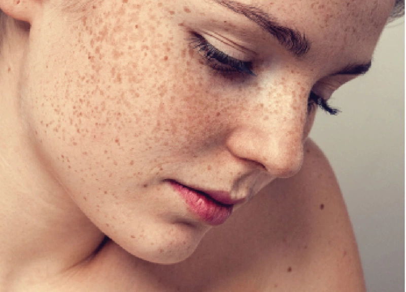 Thành phần allium cepa có trong Nacurgo gel giúp ngăn chặn sự phát triển của sắc tố melanin, ức chế quá trình hình thành nám, tàn nhang