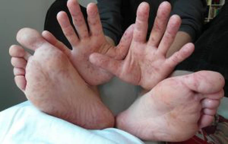 Nằm lòng các triệu chứng bệnh tay chân miệng thường gặp 2