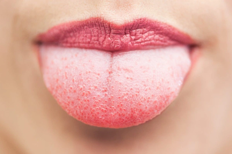 Nấm miệng bị đỏ thường gặp ở những đối tượng nào? Cách điều trị1