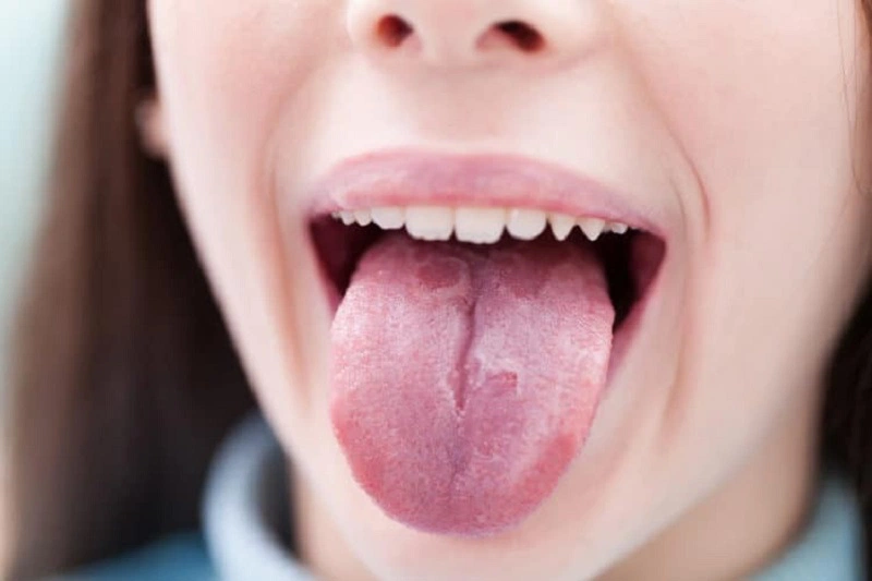 Nấm miệng HIV: Triệu chứng và cách điều trị 1