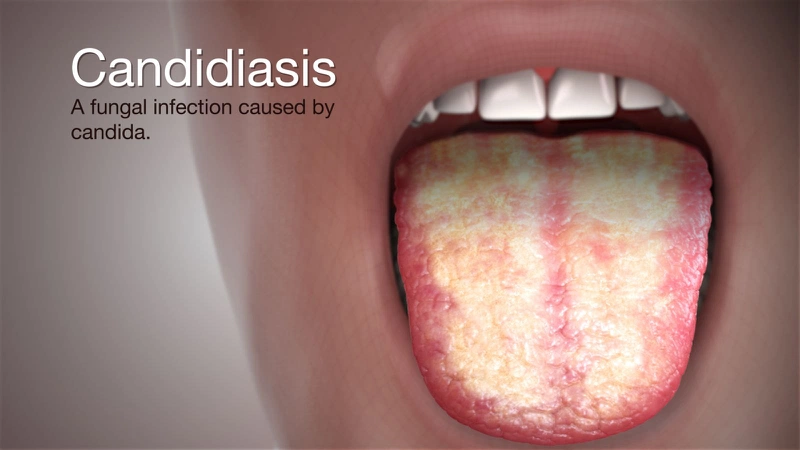 Nấm miệng là bệnh gì? Nguyên nhân, triệu chứng và cách phòng trị