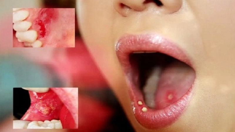 Nấm miệng là bệnh gì? Nguyên nhân, triệu chứng và cách phòng trị 3