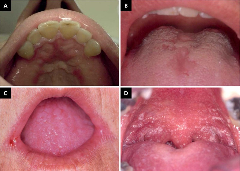 Nấm miệng là bệnh gì? Nguyên nhân, triệu chứng và cách phòng trị 2