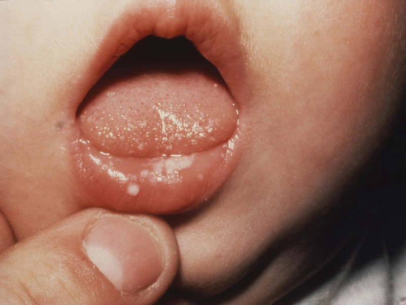 Nấm miệng ở trẻ bôi thuốc gì? - Nhà thuốc FPT Long Châu