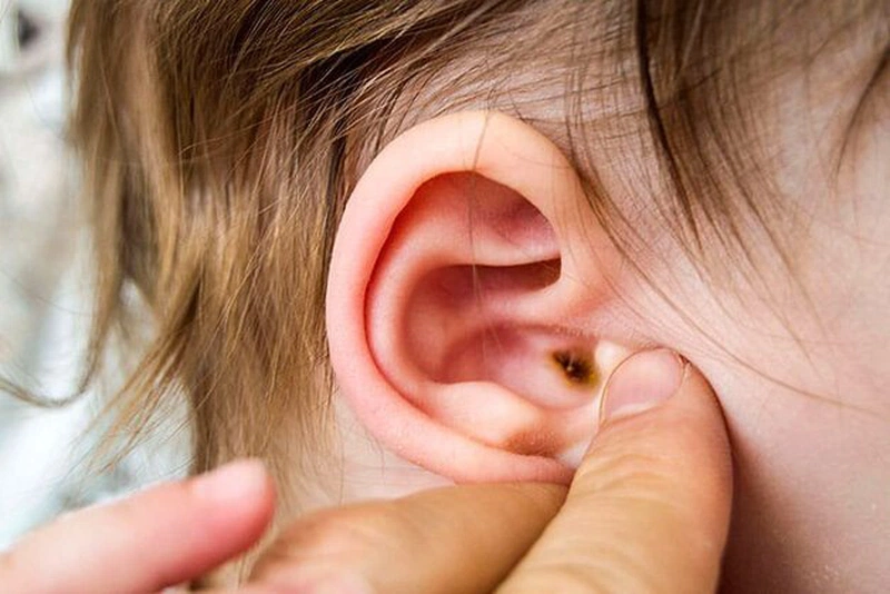 Nấm ống tai ngoài - Căn bệnh tưởng quen mà lạ! 1