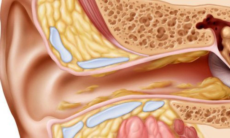 Nấm ống tai ngoài - Căn bệnh tưởng quen mà lạ! 2