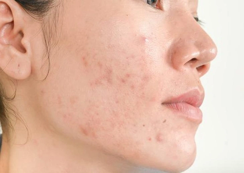 Nặn mụn xong nên làm gì để giữ cho da không thâm? 2