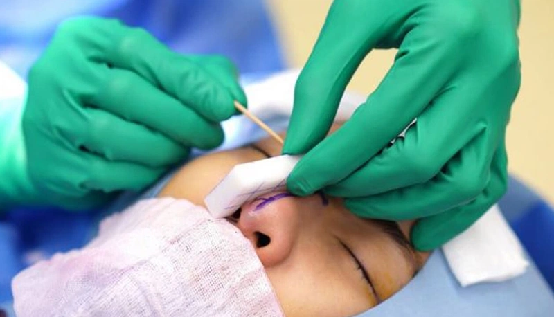 Nâng mũi bao lâu thì đầu mũi hết to? Cách giúp đầu mũi nhanh hết to 2