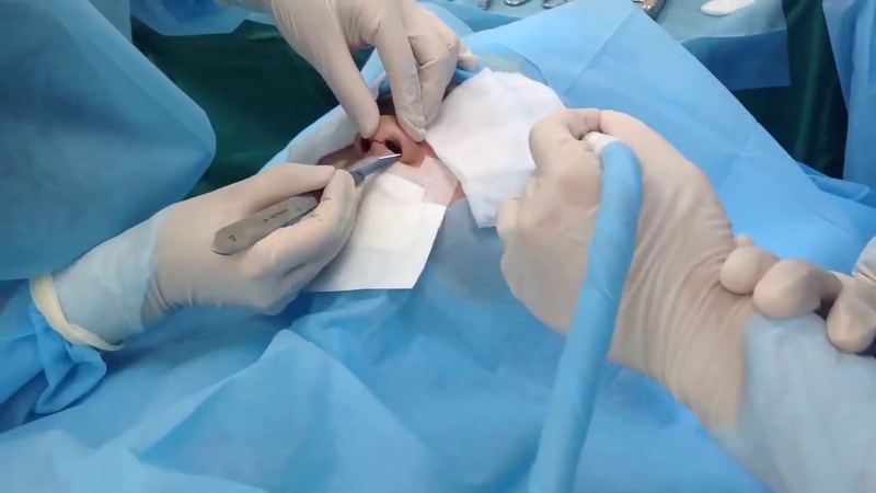 Nâng mũi bị lộ đầu mũi là gì? Có nguy hiểm không và xử lý như thế nào? 3