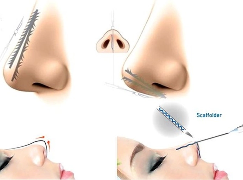 Hỏi đáp: Nâng mũi chỉ có an toàn không? 1