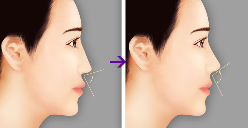 Công nghệ nâng mũi Hàn Quốc - xu hướng làm đẹp hiện nay