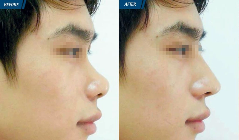 N-ng mũi L line cho nam khác nữ như thế nào? Phù hợp với đối tượng nào? 2