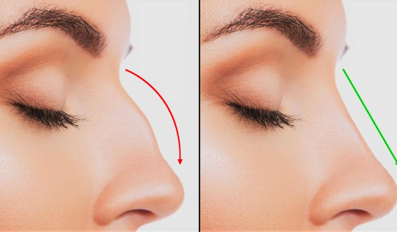 Nâng mũi sụn mỹ là gì? Nâng mũi sụn mỹ giá bao nhiêu? 1