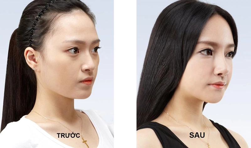 Nâng mũi sụn tự thân có an toàn không 3