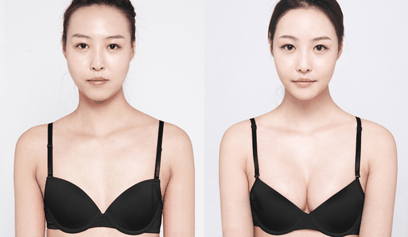 Nguyên nhân chính khiến ngực chảy xệ thường là do tuổi tác