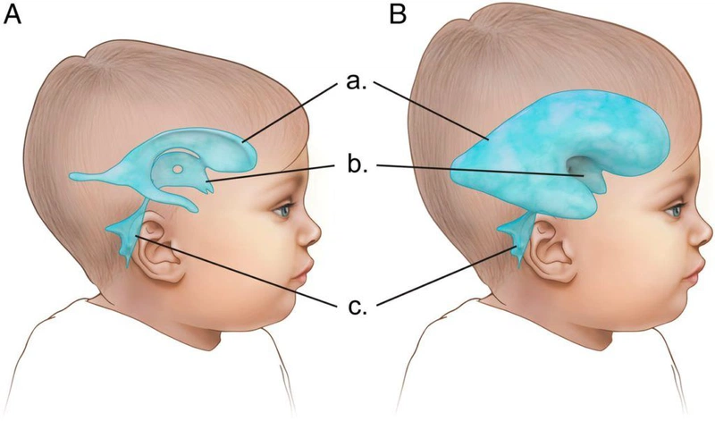 Não úng thủy là gì? Nhận biết sớm dấu hiệu não úng thủy ở trẻ em 2
