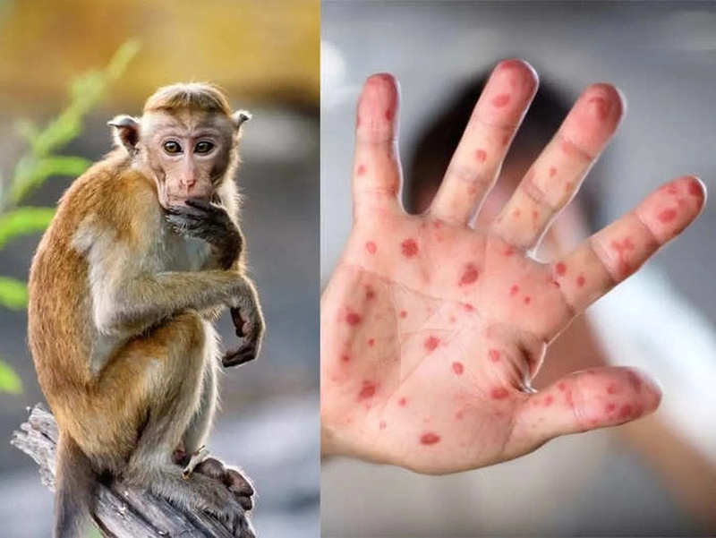 Triệu chứng và cách phòng bệnh đậu mùa khỉ2