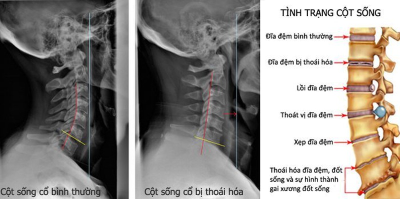 Nên chụp X quang gai cột sống khi nào và phải chuẩn bị những gì 3