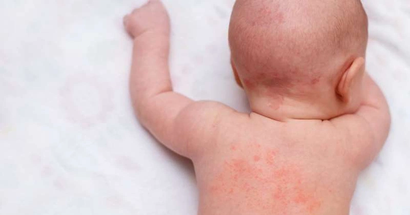 Nên hay không áp dụng cách tắm nước dừa cho trẻ sơ sinh?