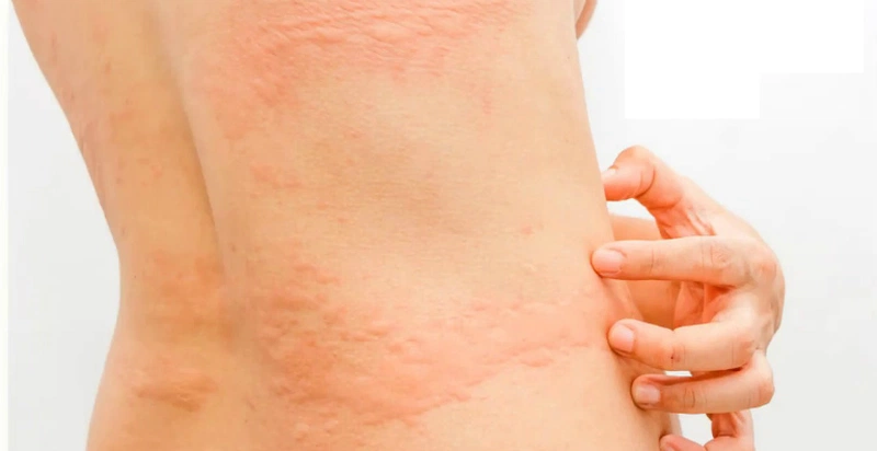 Dị ứng làm xuất hiện các mẩn đỏ gây cảm giác ngứa ngáy khó chịu