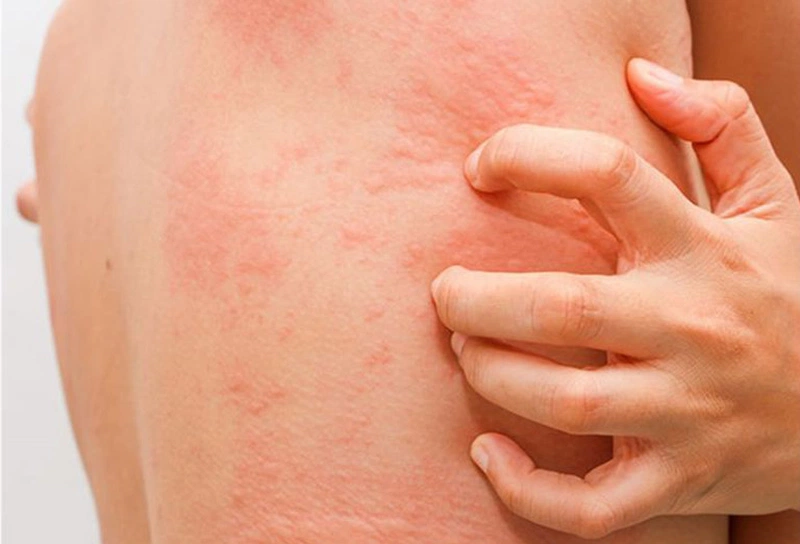 Dị ứng sau quan hệ có thể bị ở cả nam lẫn nữ hoặc 1 trong 2 người