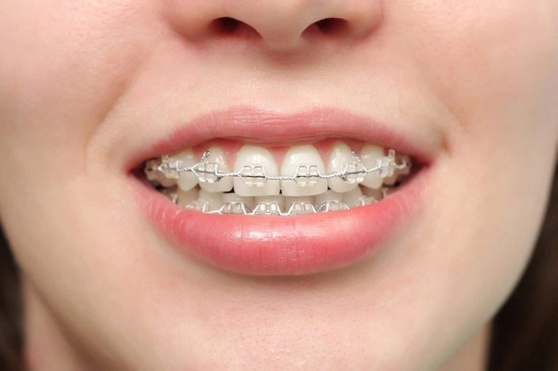 Bật mí các cách trị răng hô ngay tại nhà 2