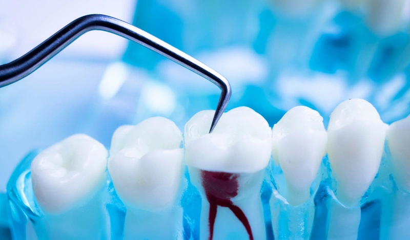 Có nhiều nguyên nhân khiến răng bị lung lay