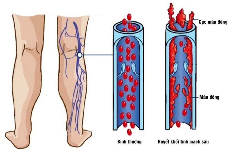 Ngăn ngừa huyết khối tĩnh mạch sâu cần làm gì? 1