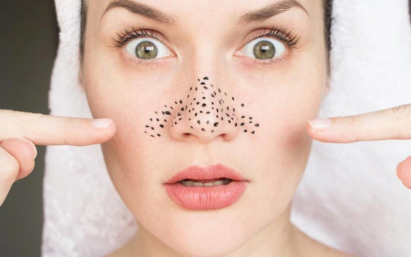 Ngăn ngừa mụn đậu đen và mụn trứng cá với sữa rữa mặt Fixderma FCL Alpha-Beta Acne Cleanser 1