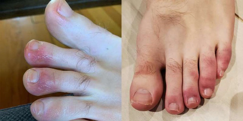 Nghi ngờ phát ban đỏ ở bàn chân là dấu hiệu của bệnh Covid-19?
