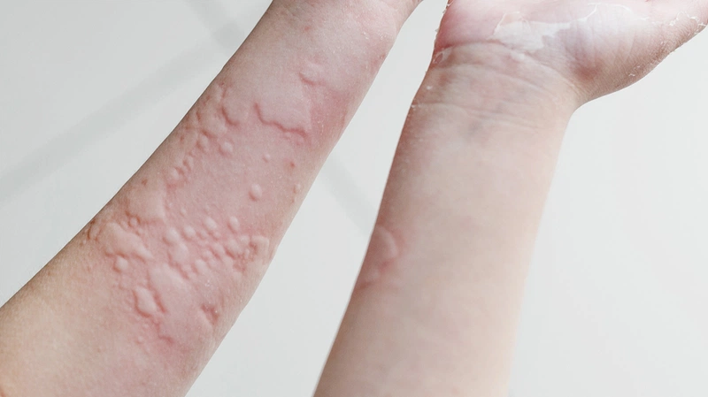 Ngộ độc gừng – bạn đã biết chưa?2