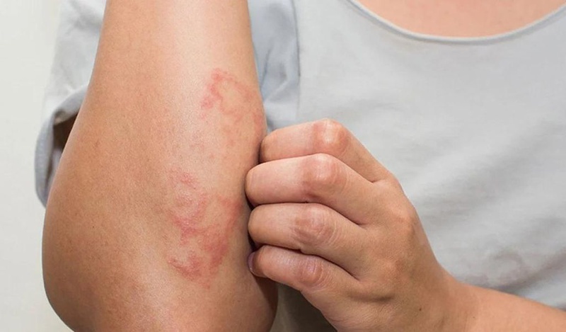 Ngộ độc quinin là gì? Có nguy hiểm không? Điều trị như thế nào? 2