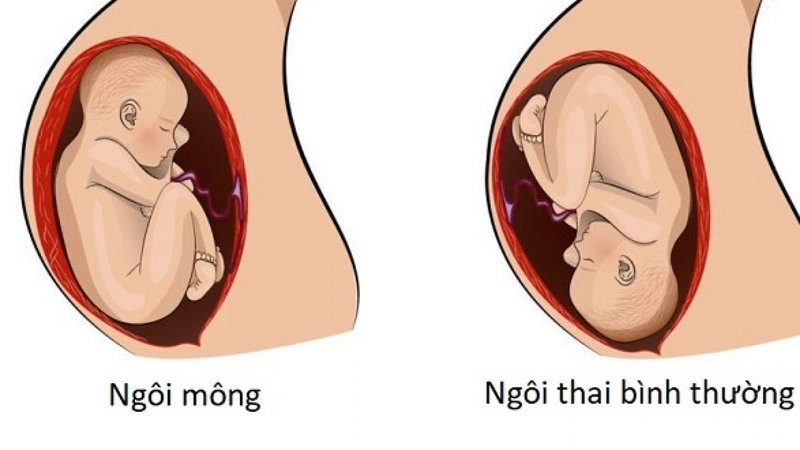 Ngôi thai đầu là gì? 1