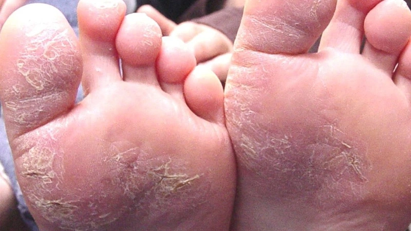 Ngón chân bị nứt cổ gà phải làm sao nhanh khỏi? 1