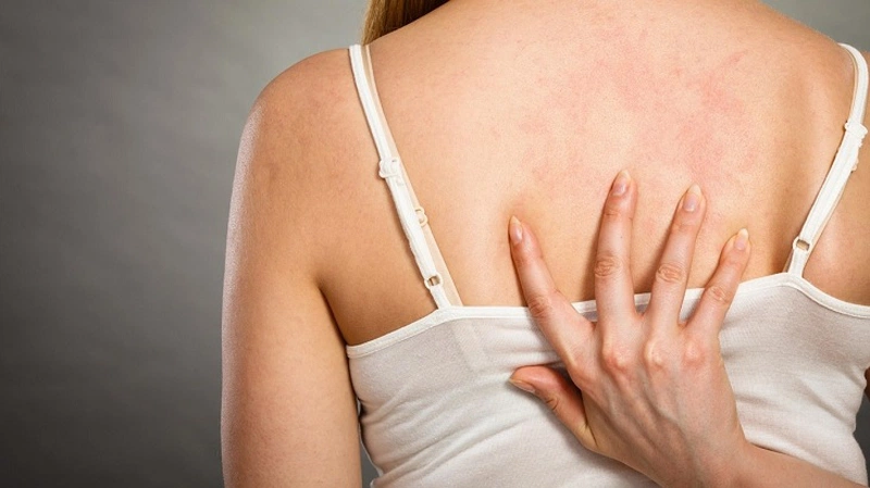 Bệnh chàm khô ở lưng và cách chữa trị an toàn 1